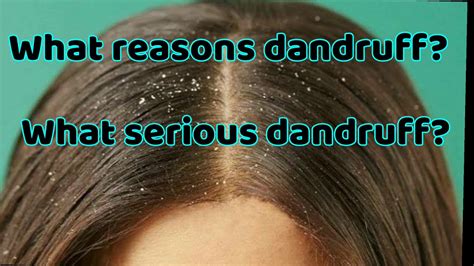 dandruff traduction|what actually is dandruff.